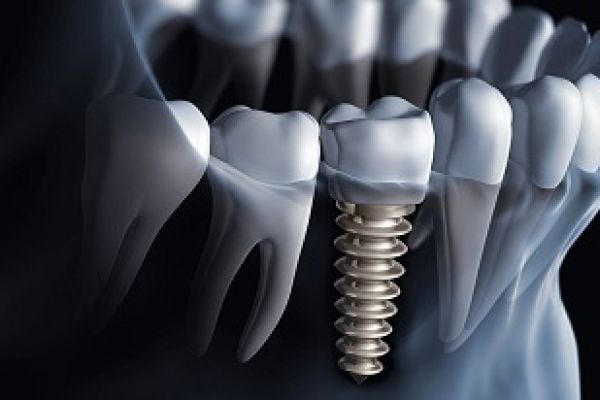 implantes-dentario6DDF37D8-97B9-45C1-8369-C231688F77D8.jpg