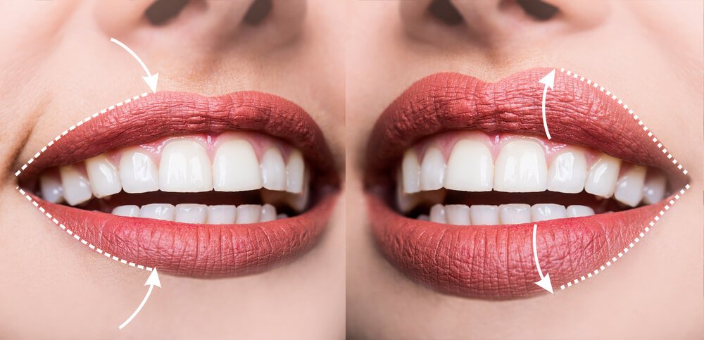 preenchimento labial antes e depois