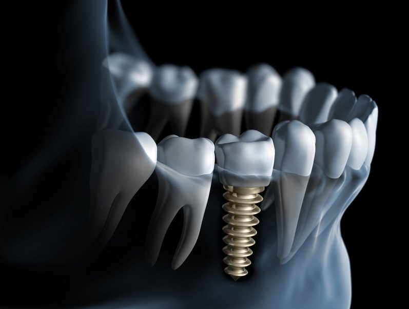 implante dentario1