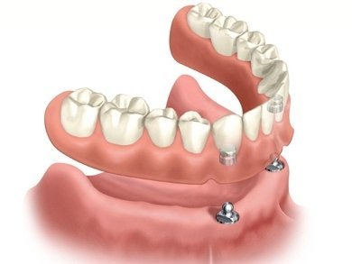 prótese dentária sobredentadura overdenture